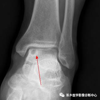 当腱鞘囊肿邂逅骨头——骨内腱鞘囊肿的影像学表现 当腱鞘囊肿邂逅骨头——骨内腱鞘囊肿的影像学表现