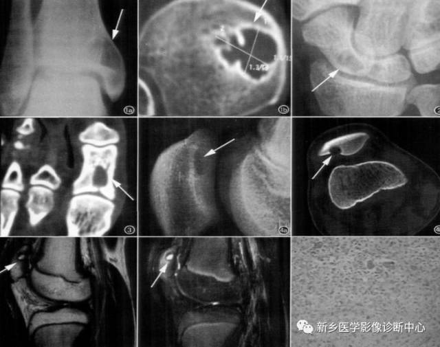 当腱鞘囊肿邂逅骨头——骨内腱鞘囊肿的影像学表现 当腱鞘囊肿邂逅骨头——骨内腱鞘囊肿的影像学表现