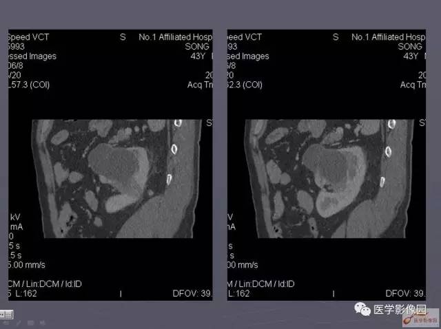 【病例】囊性肾癌1例CT影像表现与鉴别 【病例】囊性肾癌1例CT影像表现与鉴别
