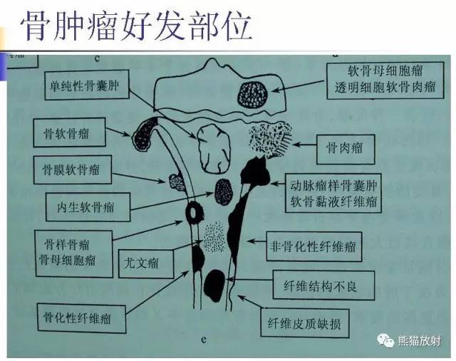 “长骨干骺端病变（皂泡样）”鉴别诊断