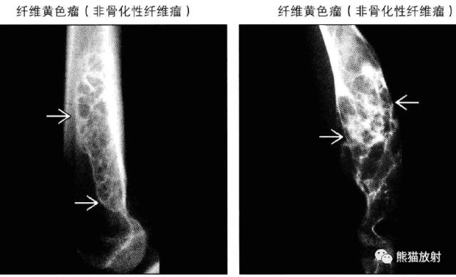“长骨干骺端病变（皂泡样）”鉴别诊断