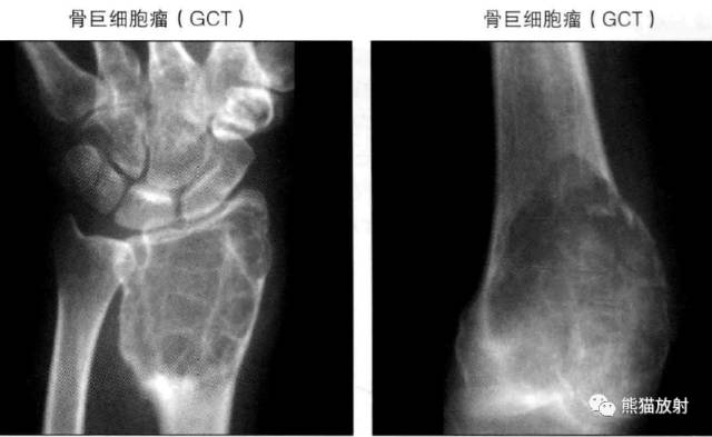 “长骨干骺端病变（皂泡样）”鉴别诊断