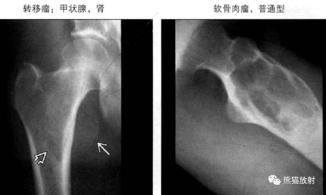 “长骨干骺端病变（皂泡样）”鉴别诊断