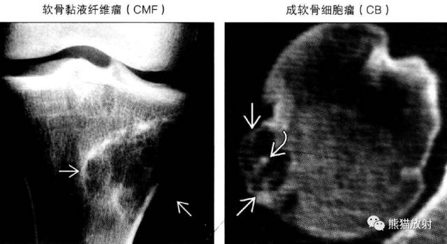 “长骨干骺端病变（皂泡样）”鉴别诊断