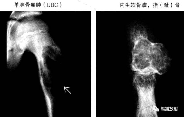 “长骨干骺端病变（皂泡样）”鉴别诊断