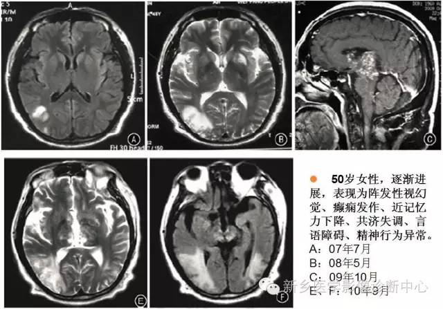 【病例解析】一个太难诊断和鉴别的疾病——PACNS 【病例解析】一个太难诊断和鉴别的疾病——PACNS