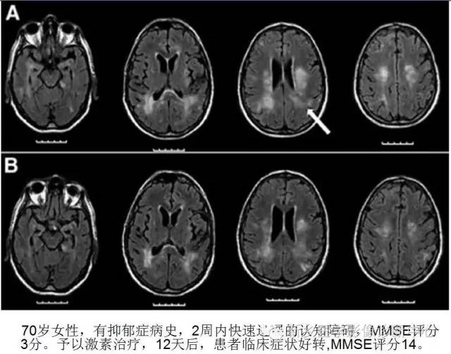 【病例解析】一个太难诊断和鉴别的疾病——PACNS 【病例解析】一个太难诊断和鉴别的疾病——PACNS