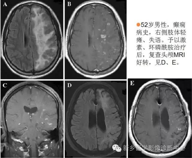 【病例解析】一个太难诊断和鉴别的疾病——PACNS 【病例解析】一个太难诊断和鉴别的疾病——PACNS