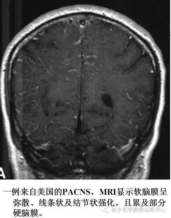 【病例解析】一个太难诊断和鉴别的疾病——PACNS 【病例解析】一个太难诊断和鉴别的疾病——PACNS