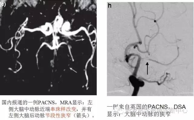 【病例解析】一个太难诊断和鉴别的疾病——PACNS 【病例解析】一个太难诊断和鉴别的疾病——PACNS