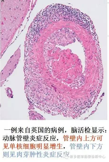 【病例解析】一个太难诊断和鉴别的疾病——PACNS 【病例解析】一个太难诊断和鉴别的疾病——PACNS