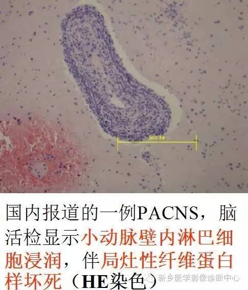 【病例解析】一个太难诊断和鉴别的疾病——PACNS 【病例解析】一个太难诊断和鉴别的疾病——PACNS