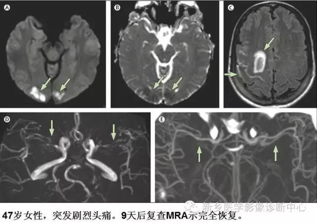 【病例解析】一个太难诊断和鉴别的疾病——PACNS