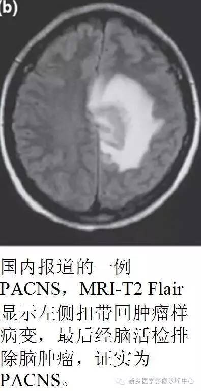 【病例解析】一个太难诊断和鉴别的疾病——PACNS 【病例解析】一个太难诊断和鉴别的疾病——PACNS