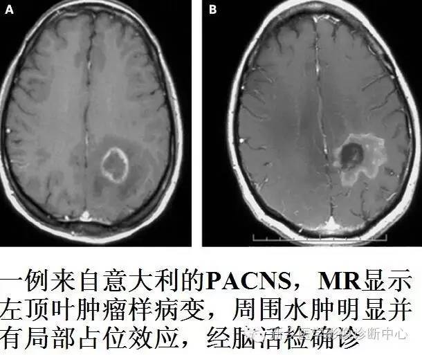 【病例解析】一个太难诊断和鉴别的疾病——PACNS 【病例解析】一个太难诊断和鉴别的疾病——PACNS
