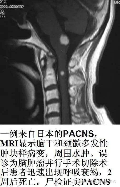 【病例解析】一个太难诊断和鉴别的疾病——PACNS 【病例解析】一个太难诊断和鉴别的疾病——PACNS