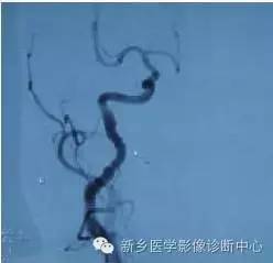 【病例解析】一个太难诊断和鉴别的疾病——PACNS 【病例解析】一个太难诊断和鉴别的疾病——PACNS