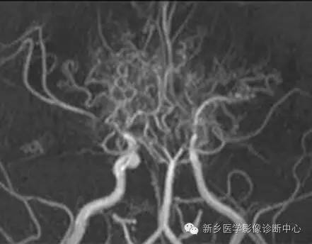 【病例解析】一个太难诊断和鉴别的疾病——PACNS 【病例解析】一个太难诊断和鉴别的疾病——PACNS