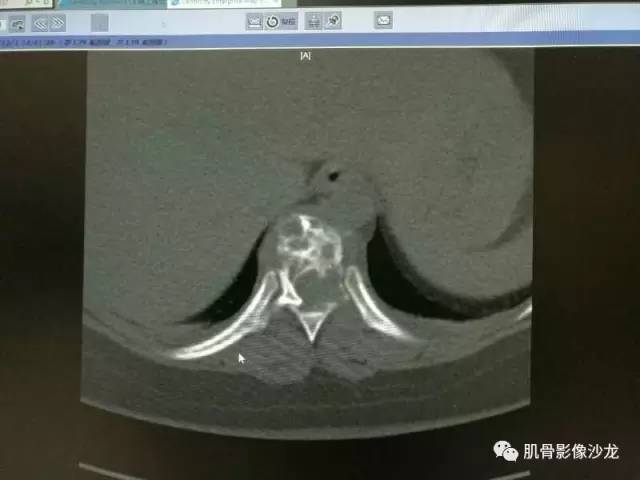 【病例】椎体血管内皮细胞瘤一例CT及MR影像讨论 【病例】椎体血管内皮细胞瘤一例CT及MR影像讨论