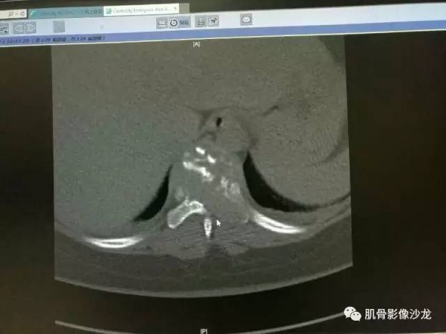 【病例】椎体血管内皮细胞瘤一例CT及MR影像讨论