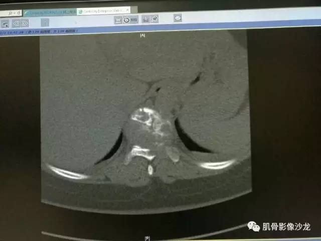 【病例】椎体血管内皮细胞瘤一例CT及MR影像讨论 【病例】椎体血管内皮细胞瘤一例CT及MR影像讨论