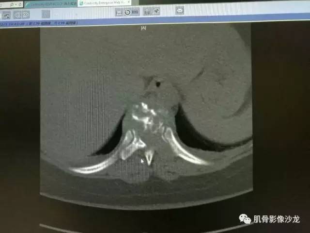 【病例】椎体血管内皮细胞瘤一例CT及MR影像讨论 【病例】椎体血管内皮细胞瘤一例CT及MR影像讨论
