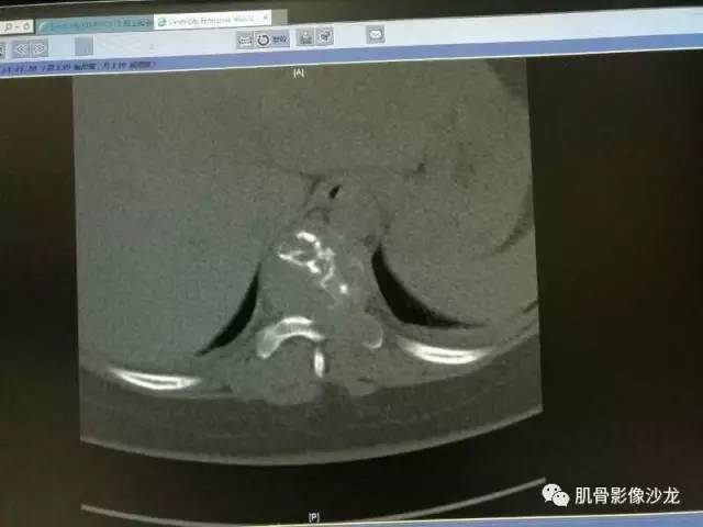 【病例】椎体血管内皮细胞瘤一例CT及MR影像讨论 【病例】椎体血管内皮细胞瘤一例CT及MR影像讨论