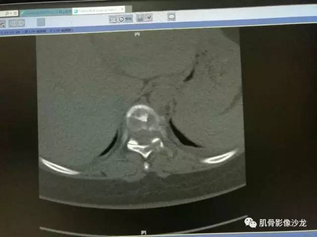 【病例】椎体血管内皮细胞瘤一例CT及MR影像讨论 【病例】椎体血管内皮细胞瘤一例CT及MR影像讨论