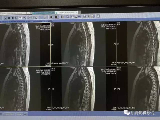 【病例】椎体血管内皮细胞瘤一例CT及MR影像讨论 【病例】椎体血管内皮细胞瘤一例CT及MR影像讨论