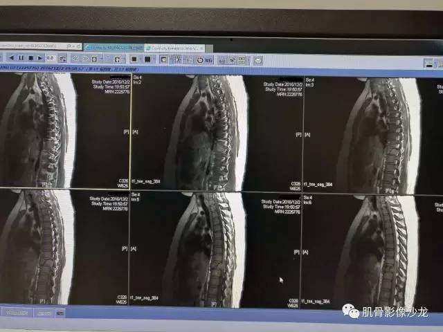 【病例】椎体血管内皮细胞瘤一例CT及MR影像讨论 【病例】椎体血管内皮细胞瘤一例CT及MR影像讨论