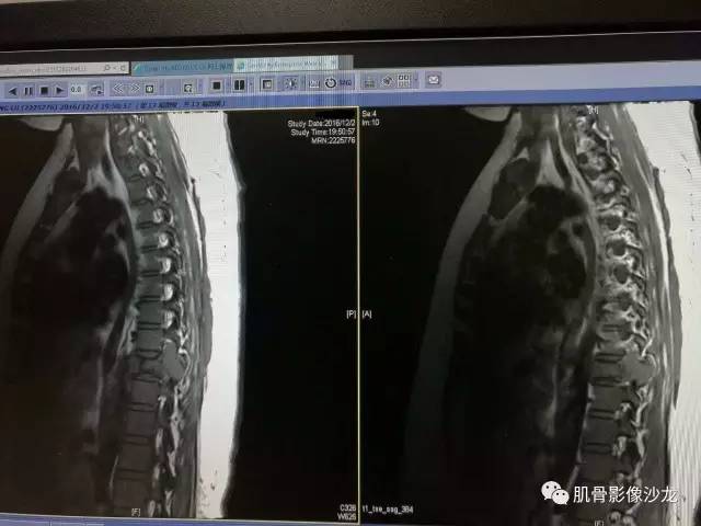 【病例】椎体血管内皮细胞瘤一例CT及MR影像讨论 【病例】椎体血管内皮细胞瘤一例CT及MR影像讨论