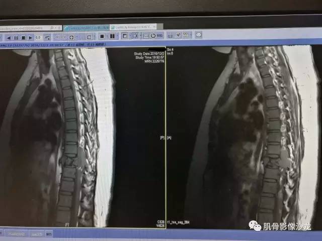 【病例】椎体血管内皮细胞瘤一例CT及MR影像讨论 【病例】椎体血管内皮细胞瘤一例CT及MR影像讨论