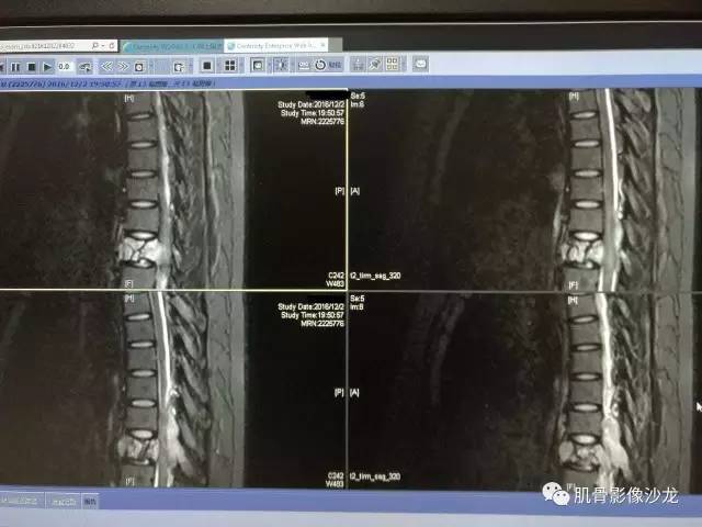 【病例】椎体血管内皮细胞瘤一例CT及MR影像讨论 【病例】椎体血管内皮细胞瘤一例CT及MR影像讨论