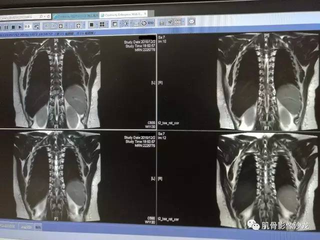 【病例】椎体血管内皮细胞瘤一例CT及MR影像讨论 【病例】椎体血管内皮细胞瘤一例CT及MR影像讨论