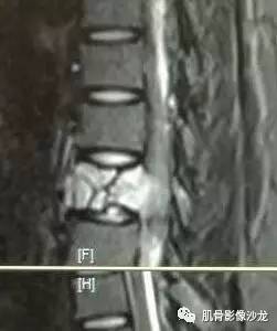 【病例】椎体血管内皮细胞瘤一例CT及MR影像讨论 【病例】椎体血管内皮细胞瘤一例CT及MR影像讨论