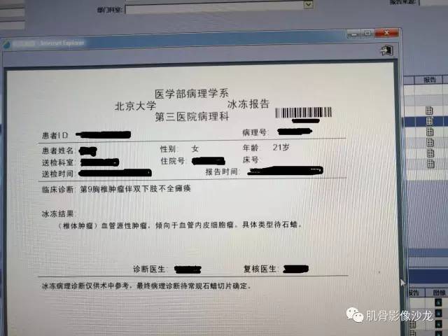 【病例】椎体血管内皮细胞瘤一例CT及MR影像讨论 【病例】椎体血管内皮细胞瘤一例CT及MR影像讨论