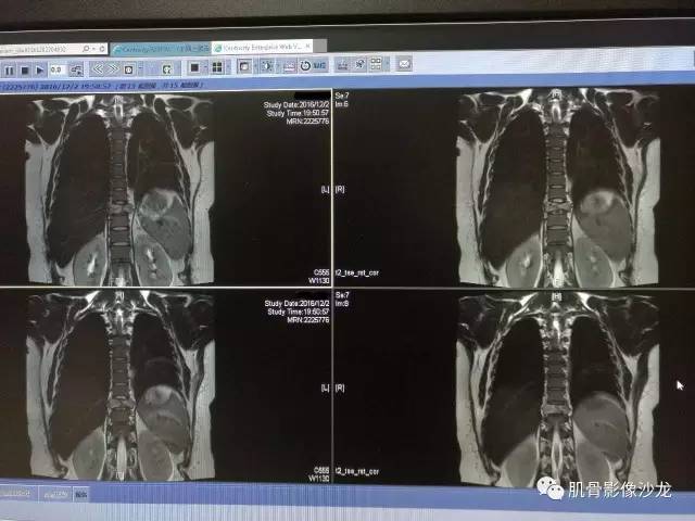 【病例】椎体血管内皮细胞瘤一例CT及MR影像讨论 【病例】椎体血管内皮细胞瘤一例CT及MR影像讨论