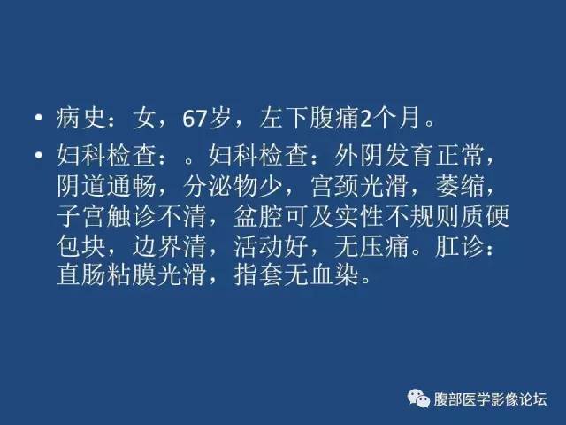 【病例】右侧卵巢卵泡膜细胞瘤1例CT影像表现