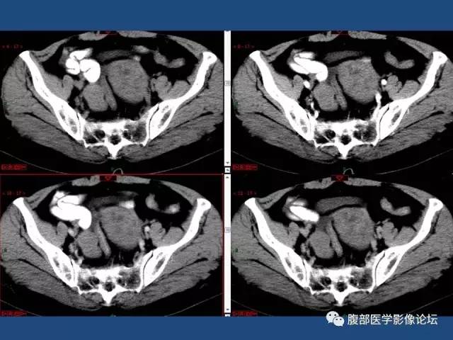 【病例】右侧卵巢卵泡膜细胞瘤1例CT影像表现