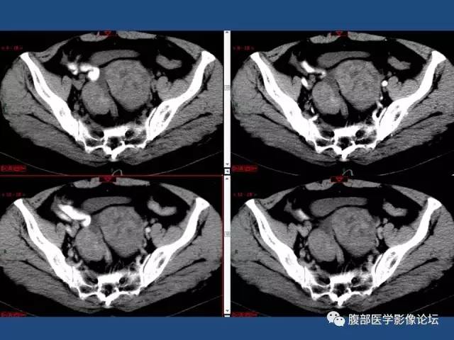 【病例】右侧卵巢卵泡膜细胞瘤1例CT影像表现