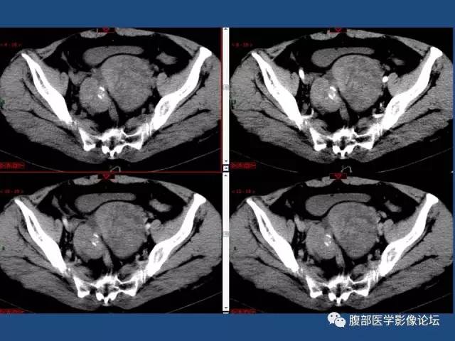 【病例】右侧卵巢卵泡膜细胞瘤1例CT影像表现