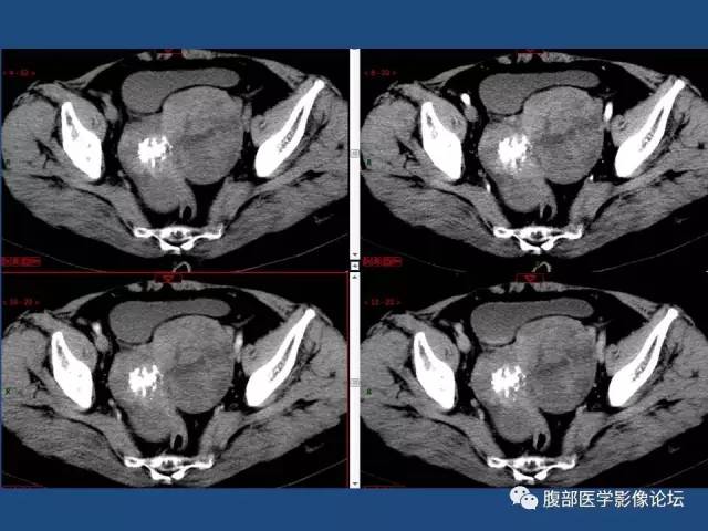【病例】右侧卵巢卵泡膜细胞瘤1例CT影像表现