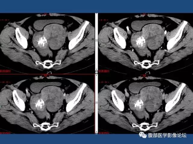 【病例】右侧卵巢卵泡膜细胞瘤1例CT影像表现
