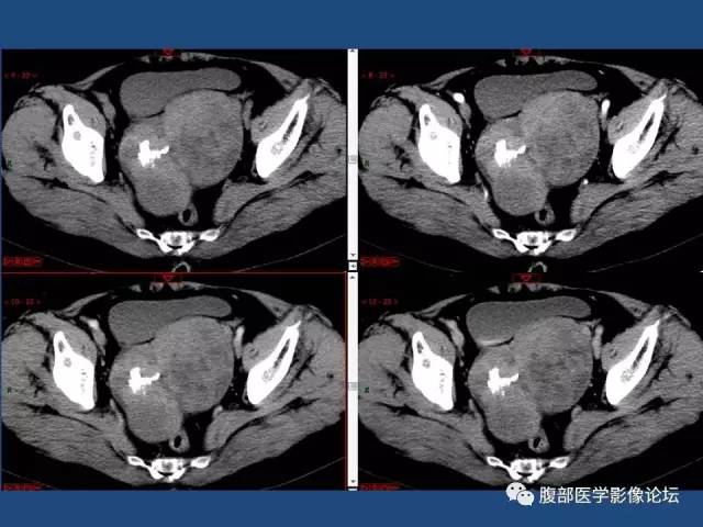 【病例】右侧卵巢卵泡膜细胞瘤1例CT影像表现