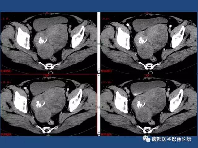 【病例】右侧卵巢卵泡膜细胞瘤1例CT影像表现