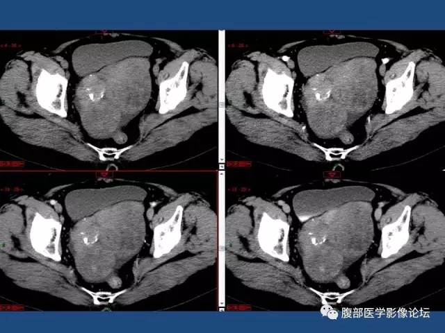 【病例】右侧卵巢卵泡膜细胞瘤1例CT影像表现