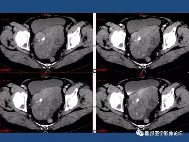 【病例】右侧卵巢卵泡膜细胞瘤1例CT影像表现