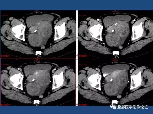 【病例】右侧卵巢卵泡膜细胞瘤1例CT影像表现
