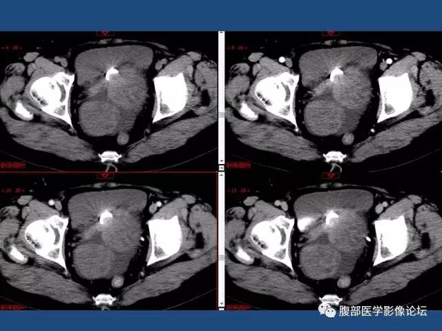 【病例】右侧卵巢卵泡膜细胞瘤1例CT影像表现
