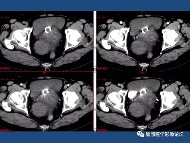 【病例】右侧卵巢卵泡膜细胞瘤1例CT影像表现